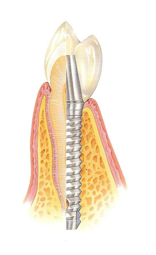 Zub a zubný implantát