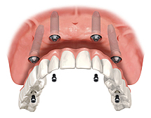 Implantové mostíky namiesto zubnej protézy..