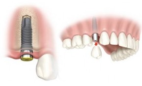 Náhrada jedného zubu zubným implantátom