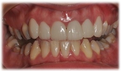 Zuby po ošetrení