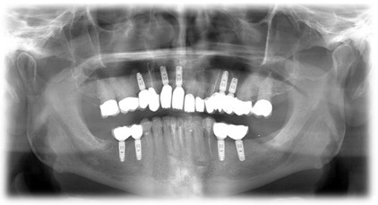 Zuby po ošetrení