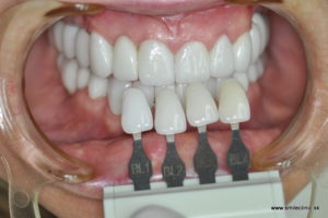 Vzorkovník žiarivo bielych zubov