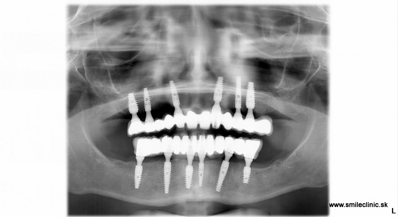 Konečný snímok pacientky po nasadení trvalého mostíka na implantáty počas celkovej narkózy