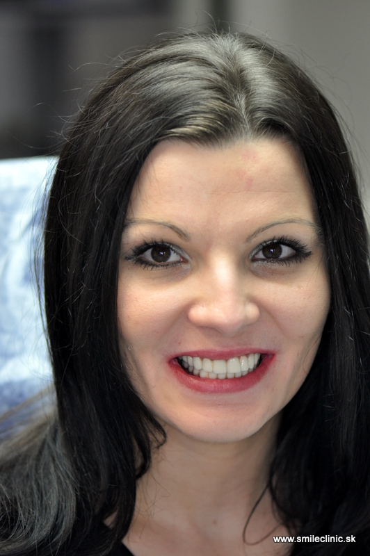zubné implantáty