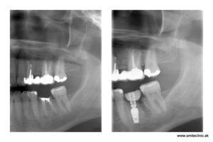 zlomený zub a zubný implantát