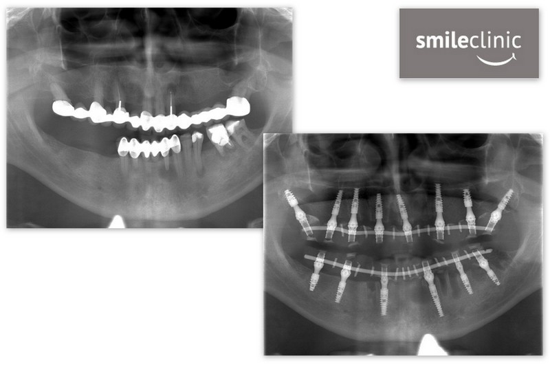 OPG snímok pred a po implantácii 