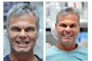  pred a po zubnom ošetrení