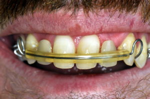 Dočasná náhrada chýbajúcich zubov - medzerník