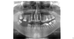 Snímok zubné implantáty
