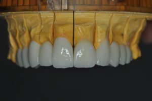 Zirconium dental crowns before fitting 