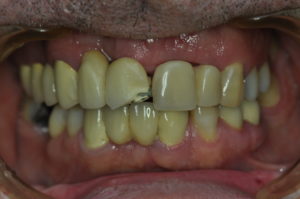 zubný mostík
