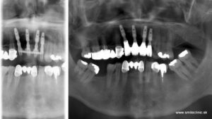 opg snímok po implantácii s provizórnymi korunkami a po nasadený keramických zubných koruniek