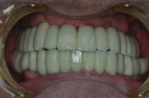 fixný mostík na zubných implantátoch