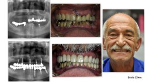 Zubné korunky a zubné implantáty
