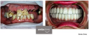 Zuby pred a po ošetrení