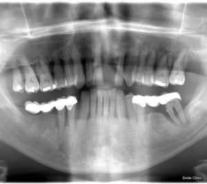 OPG snímok pred ošetrenín / dental X-ray before the treatment