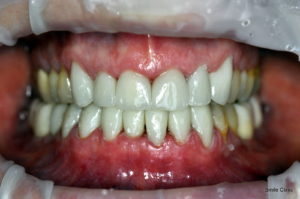 Completed smile - dental crowns + dental implants