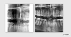 zlomený zub nahradený zubným implantátov