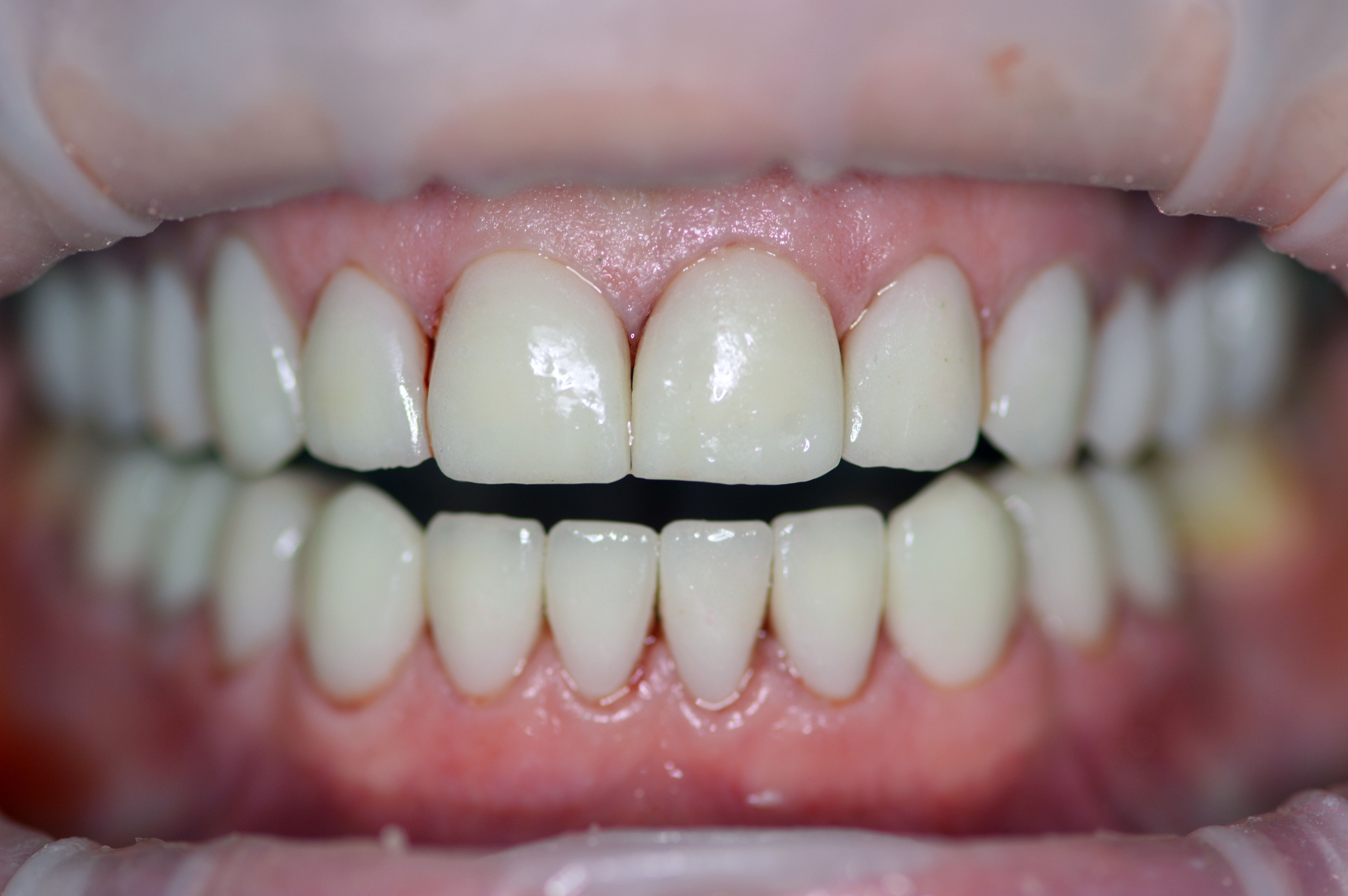 smile after the treatment with dental crowns