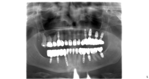 Deborahs X ray AFTER treatmnet with dental implants