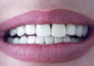 Úsmev pani Alenky PO ošetrení pomocou implantátov a zubných koruniek