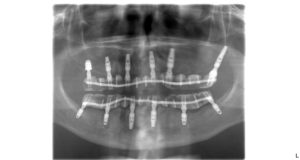 Dental implants have been fit