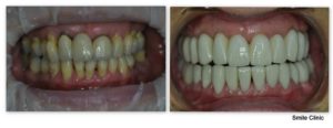 Zuby pacientky PRED ošetrením a PO ošetrení