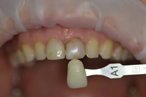 Zuby pacientky Kate PRED ošetrením 
